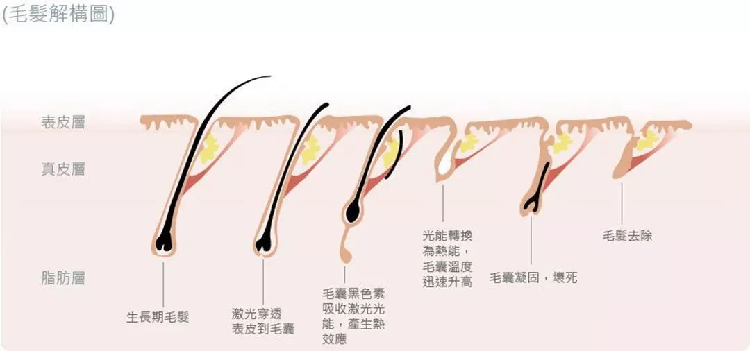 “白煮蛋”與“獼猴桃”之間，還差一個(gè)它 強(qiáng)脈沖脫毛器械，值得買嗎？