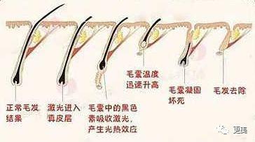 強(qiáng)脈沖脫毛技術(shù)與單部位色素沉著的機(jī)制解析——以劉亦菲“黑部”輿情為例
