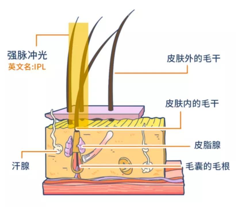 家用脫毛儀真實評測 強脈沖光技術到底靠不靠譜？